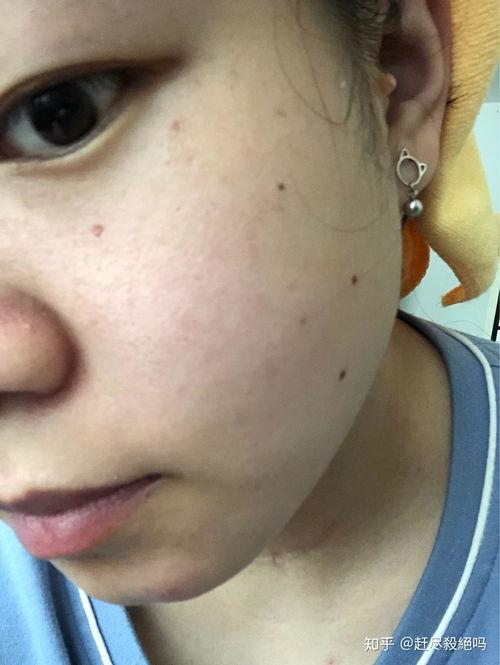 点痦子视频,传统美容秘术的现代演绎